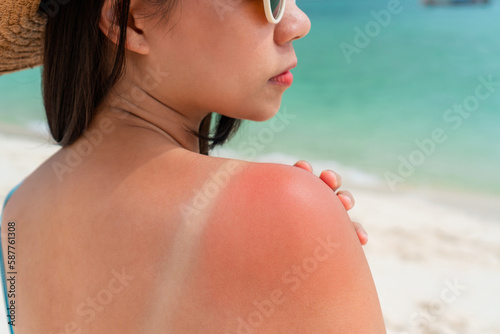 Sunburned skin on shoulder of a woman because of not using cream with sunscreen protection. Red skin sun burn after Sunbathing at the beach. Summer and holiday concept photo