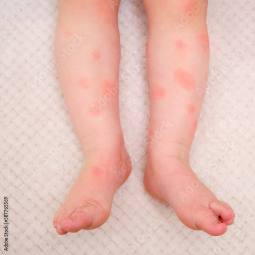 Toddler baby skin care, allergies and dermatitis. Red spots of allergy and atopic dermatitis on the child skin. Kid aged one year eight months