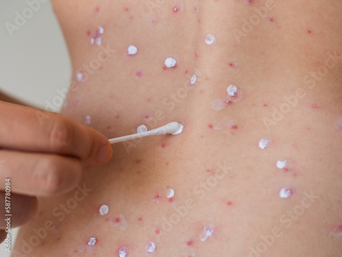 A mother hand holding a cotton swab and rubbing chickenpox blisters on teenager skin with Calamine lotion.