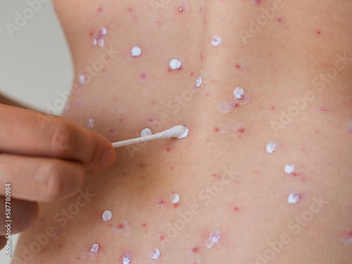 A mother hand holding a cotton swab and rubbing chickenpox blisters on teenager skin with Calamine lotion. photo