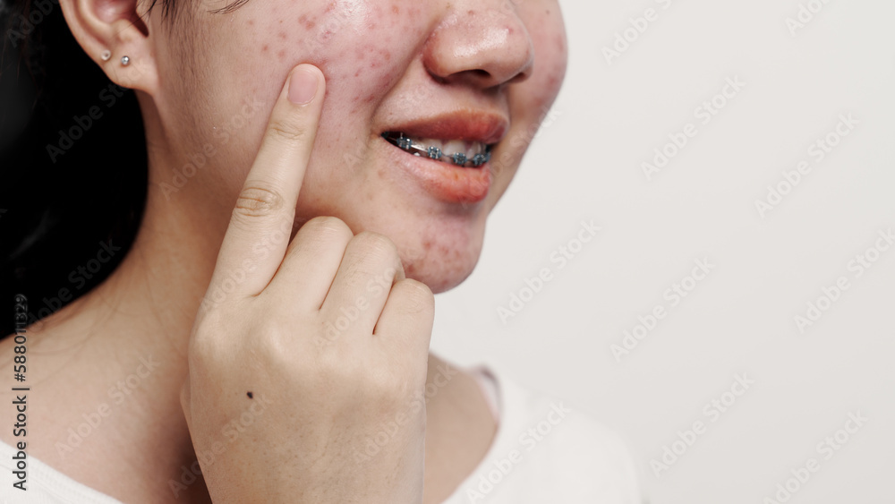 Asian teenage with acne face skin problem, Dermatological disease, white background. Asian teenage with acne face skin problem, Dermatological disease, white background.