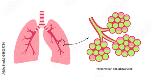 Pneumonia infection poster