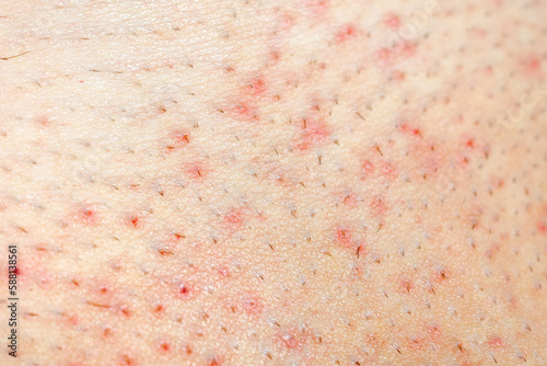 Texture of human skin with many ingrown hairs. Extreme close up macro Skin with keratosis pilaris.  photo