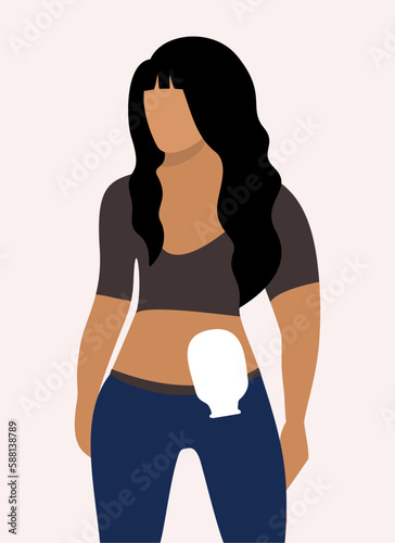 Colostomy bag. Young woman wearing colostomy bag. Vector isolated illustration. photo