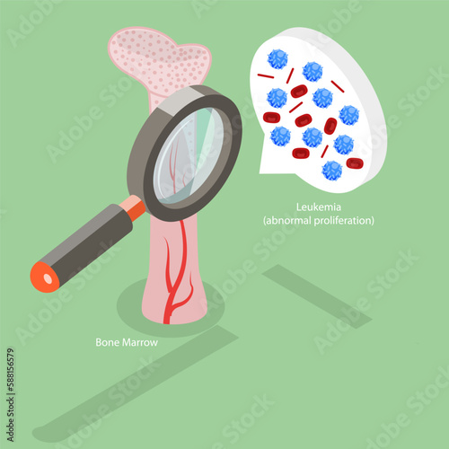 3D Isometric Flat Vector Conceptual Illustration of Leukemia Disease, Bone Marrow Anatomy