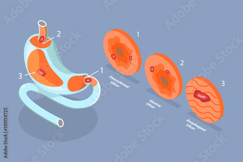 3D Isometric Flat Vector Conceptual Illustration of Peptic Ulcer Stomach Disease, Gastritis and Inflammation