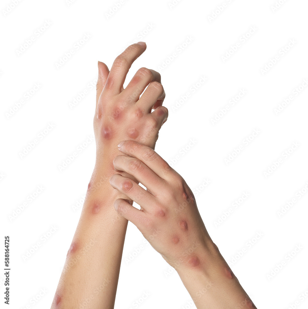 Woman with rash suffering from monkeypox virus on white background, closeup Woman with rash suffering from monkeypox virus on white background, closeup