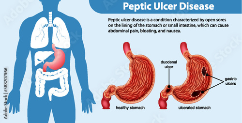 Peptic Ulcer Disease Infographic