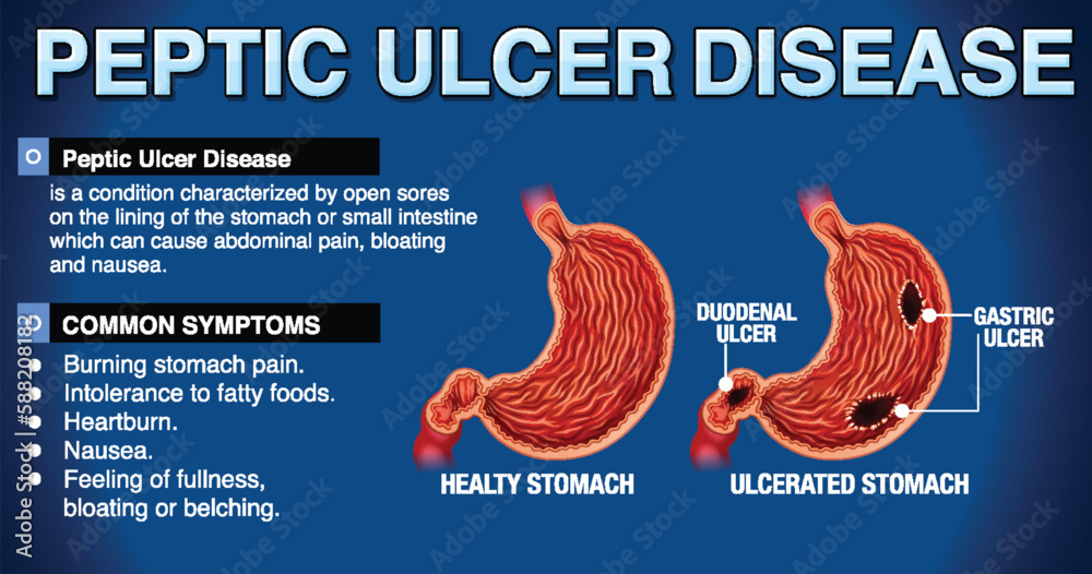 Peptic Ulcer Disease Explained Infographic Stock Vector | Adobe Stock