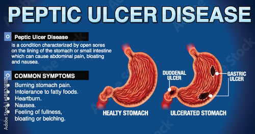 Peptic Ulcer Disease Explained Infographic