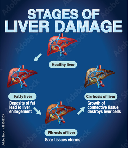 Stages of Liver Damage Infographic