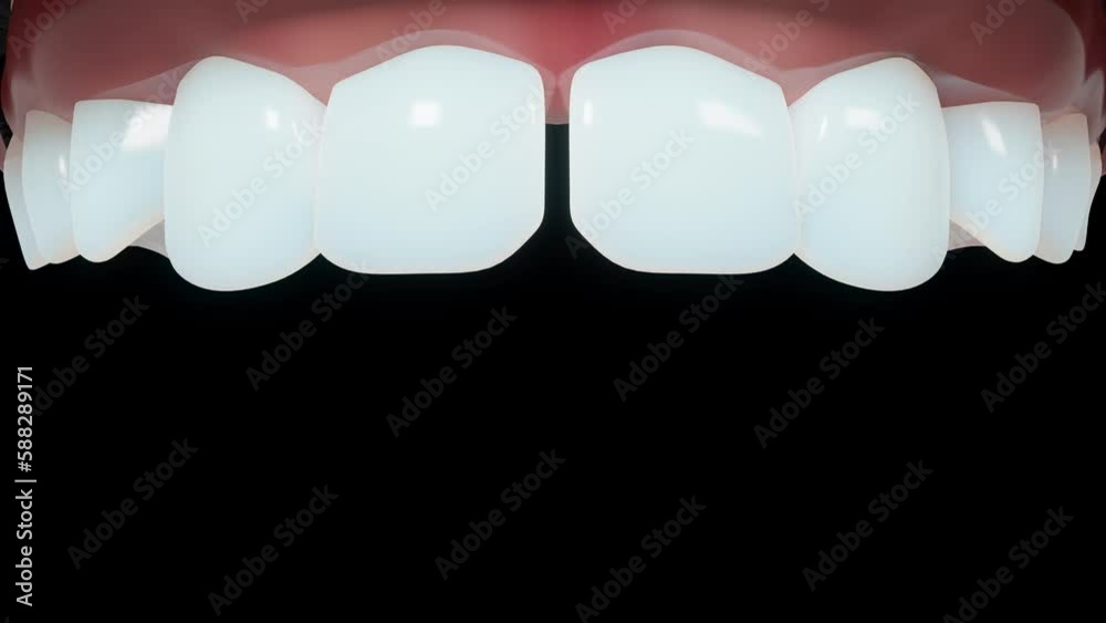 3D animation of the transformation from decayed yellow discolored teeth ...