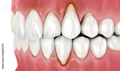 Gingiva recession. 3D illustration of dental disease photo