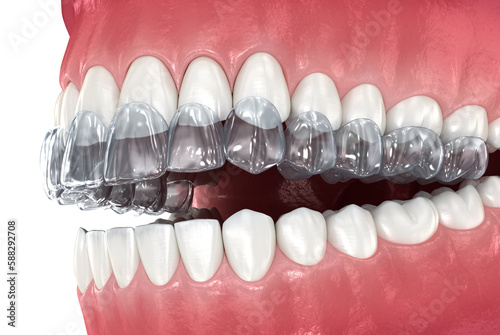 Bite Splint - bruxism protection. Medically accurate dental 3D illustration photo