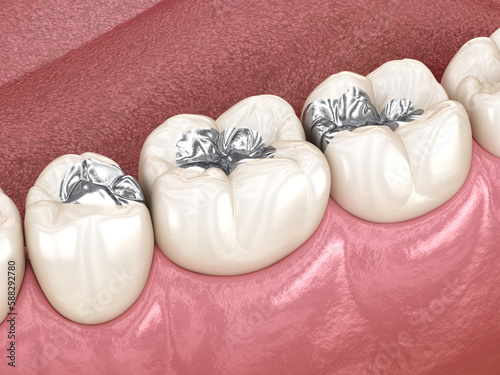 Amalgam restoration. Medically accurate 3D animation of dental concept