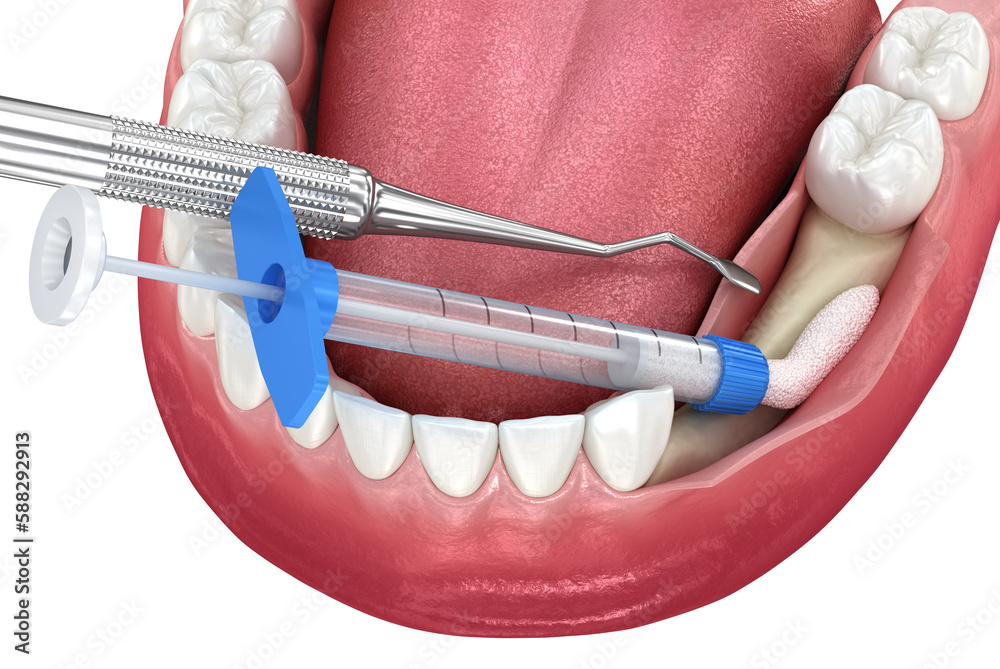 Bone grafting augmentation for tooth implantation. Medically accurate 3D illustration. - obrazy, fototapety, plakaty 