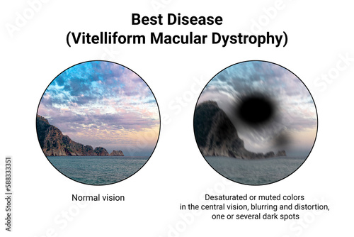 The difference between the vision of a normal eye and an eye affected by Best disease, illustration photo