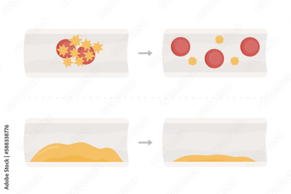 Beneficios Omega 3. Infografía en arterias y venas. Disminución de