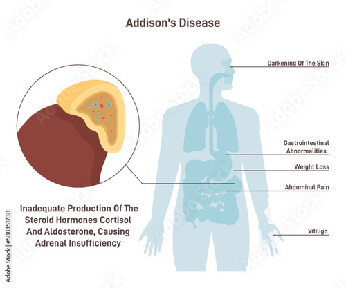 Addison's disease. Symptoms of chronic adrenal insufficiency or hypocortisolism photo