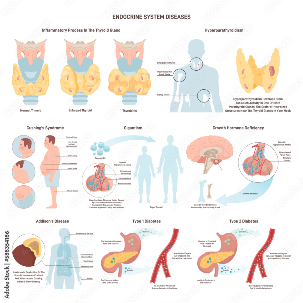 Endocrine system organ disease set. Human glands function disorders