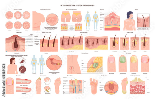 Integumentary system pathologies set. Skin, glands, hair and nail disorders