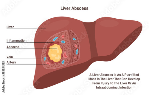 Liver abscess. Human internal organ tissue inflammation and pus formation.