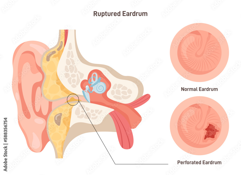 Ruptured eardrum. Anatomy of the human ear. Healthy and perforated