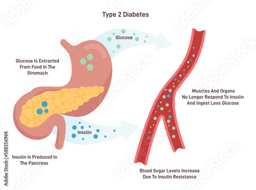 Type 2 diabetes medical vector illustration with english description photo