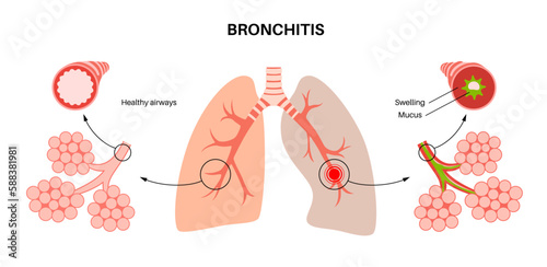 Bronchitis lung disease photo