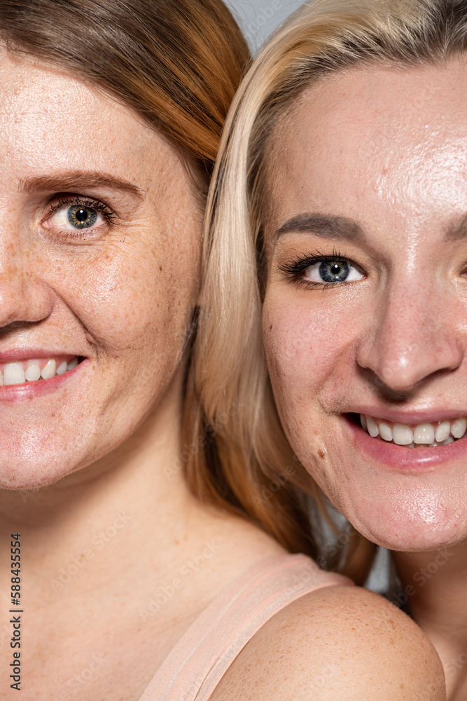 Cropped view of smiling women with skin issue looking at camera isolated on grey. Cropped view of smiling women with skin issue looking at camera isolated on grey.