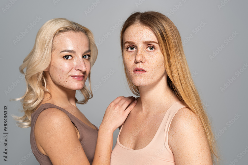Smiling woman with acne on face standing near model with freckles isolated on grey. Smiling woman with acne on face standing near model with freckles isolated on grey.