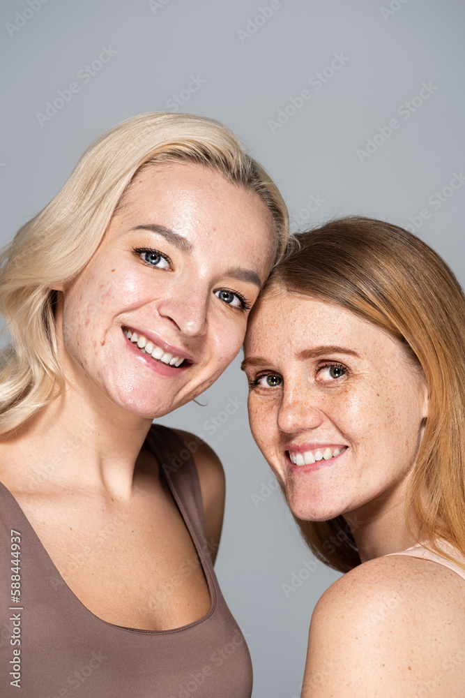 Happy friends with problem skin looking at camera while smiling isolated on grey. Happy friends with problem skin looking at camera while smiling isolated on grey.