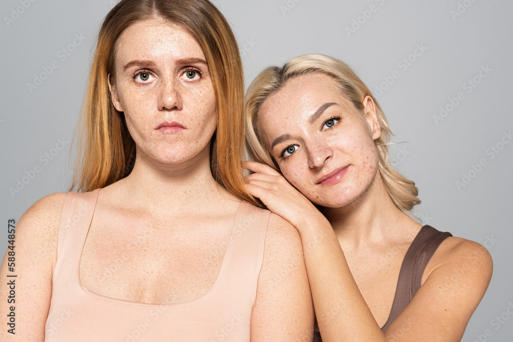 Blonde woman with acne on face standing near friend with freckles isolated on grey. Blonde woman with acne on face standing near friend with freckles isolated on grey.