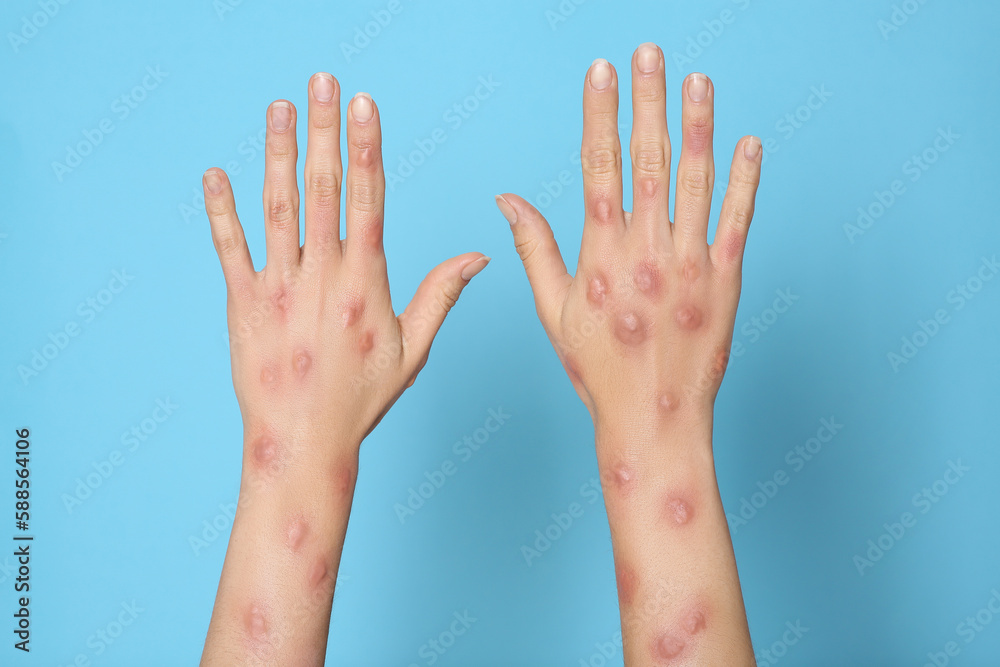 Woman with rash suffering from monkeypox virus on light blue background, closeup