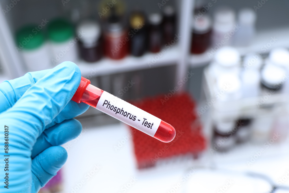 Obraz premium Phosphorus test to look for abnormalities from blood