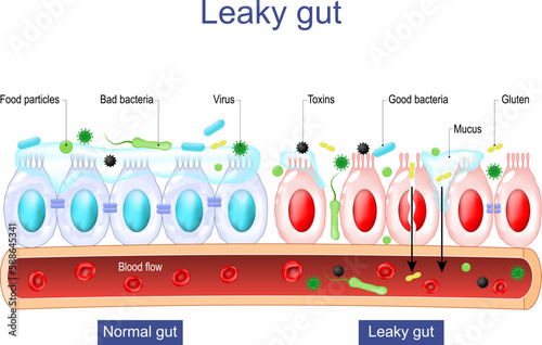 Leaky gut. Intestinal permeability. Gut barrier dysfunction.