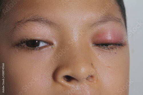 swollen eye pain in children photo