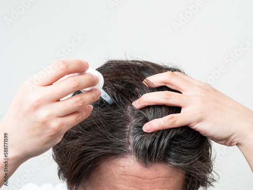 頭皮に育毛剤を塗る男性 スカルプケア