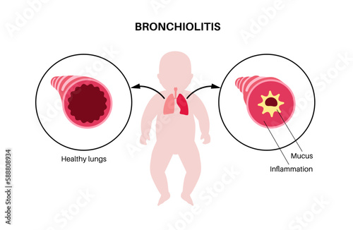 Bronchiolitis lung disease