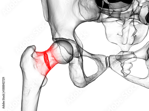 Obraz na plátně A fracture of the femur neck, a common type of hip fracture that typically occur