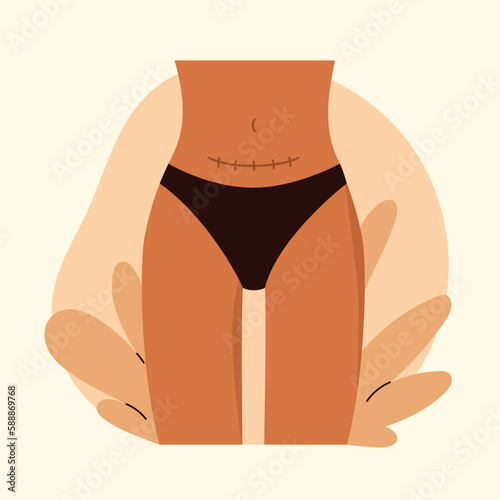 Cesarean scar. Stitches after caesarean section on female belly. C-section, surgical delivery operation concept. Vector illustration in cartoon style. Isolated white background. photo