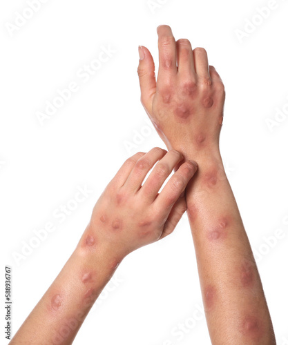 Woman with rash suffering from monkeypox virus on white background, closeup © New Africa