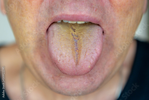 Quadro su tela A man open his mouth stick out the tongue from, White tongue is  is poor oral hygiene, The result of an overgrowth and swelling of the fingerlike projections (papillae) on the surface of your tongue