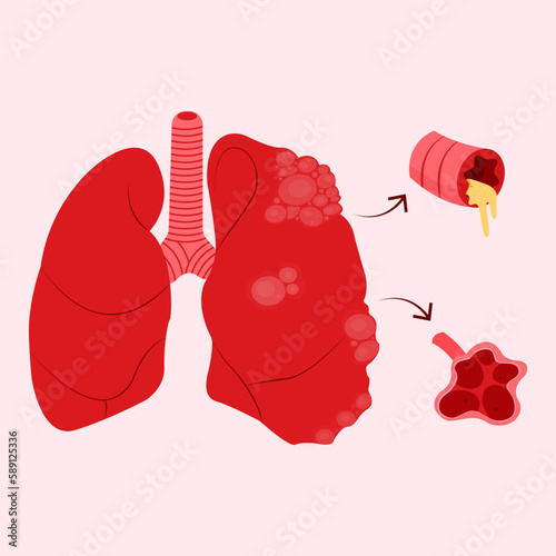 Illustration of a diseased lung affected by COPD (Chronic Obstructive Pulmonary Disease), perfect for medical presentations or educational materials.