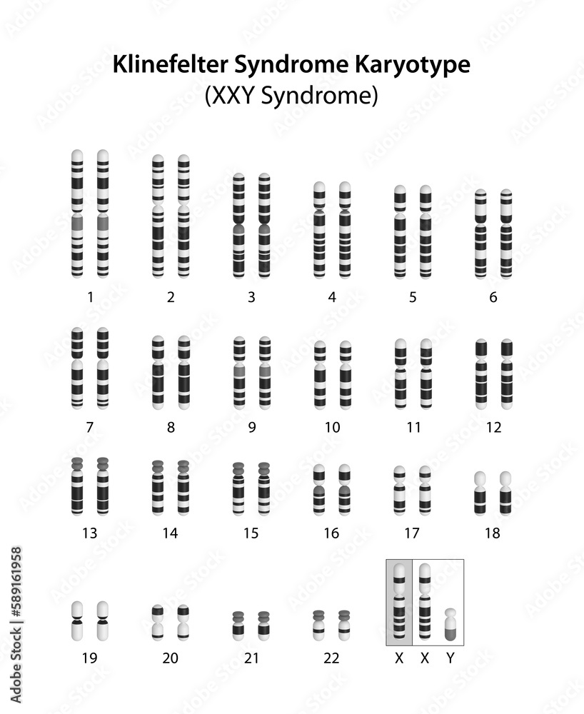 Klinefelter Syndrome Xxy Syndrome Karyotype Stock Illustration