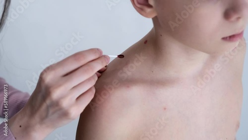 Mom lubricates the rash from chickenpox on son's body and back with with red antiseptic using cotton buds.11-year-old boy suffers from chickenpox. Varicella blisters lubricated with antiseptic drug,