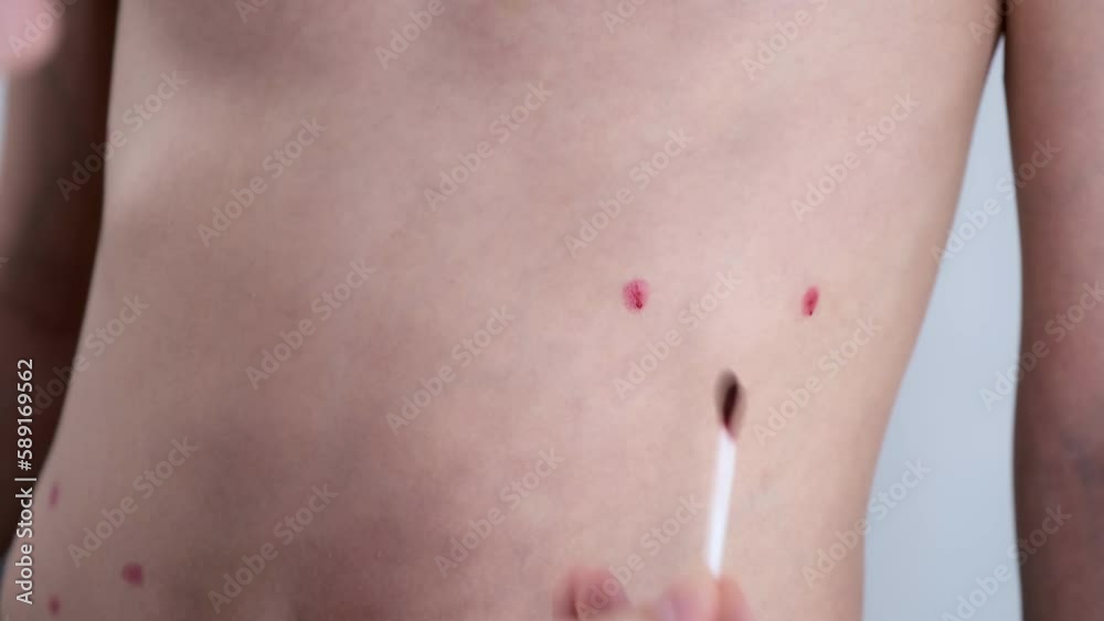 Mom lubricates the rash from chickenpox on son's body and abdomen with with red antiseptic using cotton buds.11-year-old boy suffers from chickenpox. Varicella blisters applying with antiseptic drug,