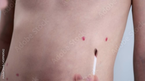 Mom lubricates the rash from chickenpox on son's body and abdomen with with red antiseptic using cotton buds.11-year-old boy suffers from chickenpox. Varicella blisters applying with antiseptic drug,