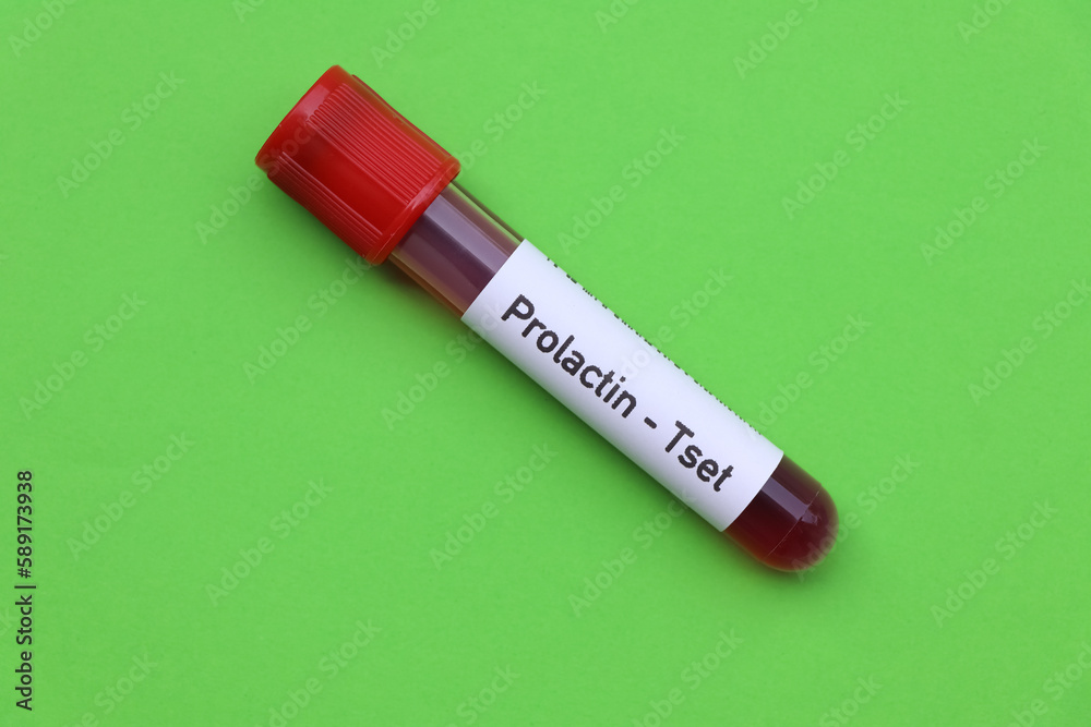 Prolactin test to look for abnormalities from blood Prolactin test to look for abnormalities from blood