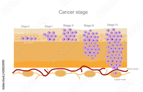 The cancer stage (0 - VI) that represents the abnormal cell in stage 0 to the cell metastasis in stage VI.